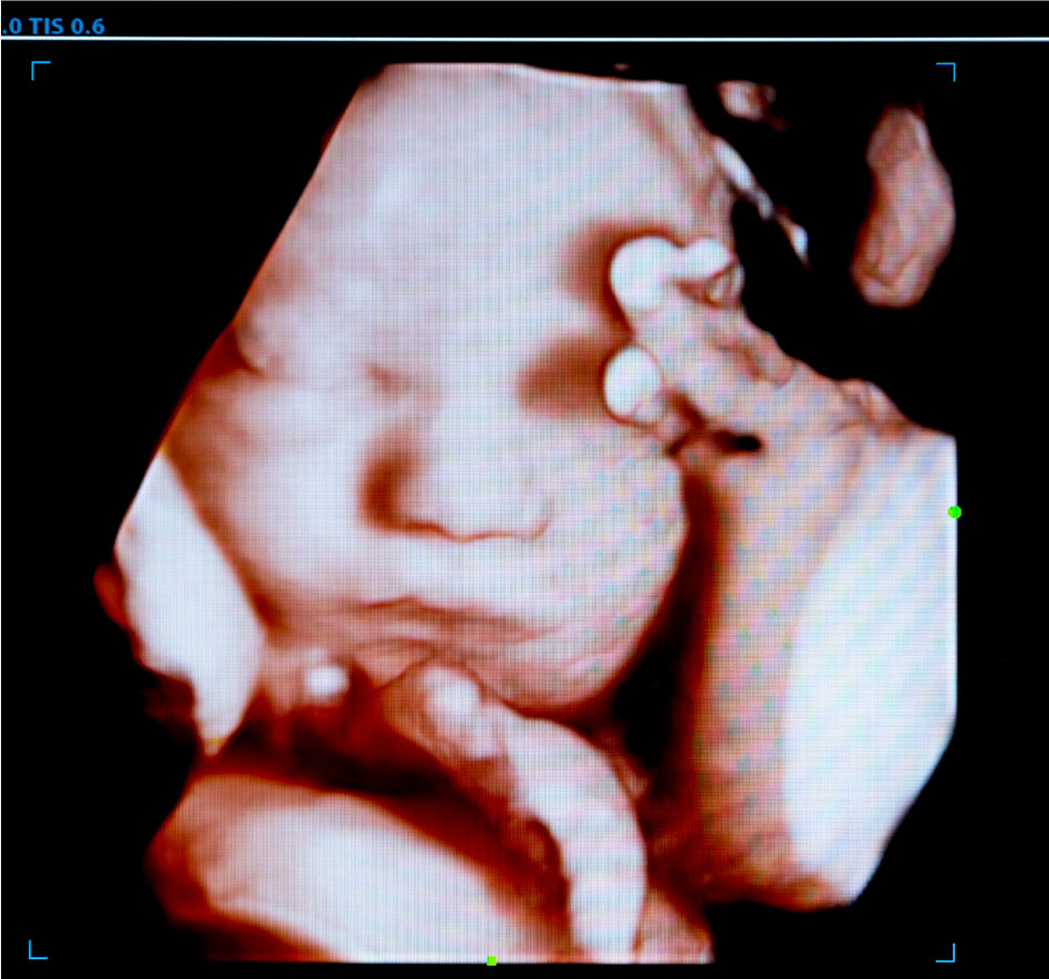 3D Ultrasound photo with baby's face