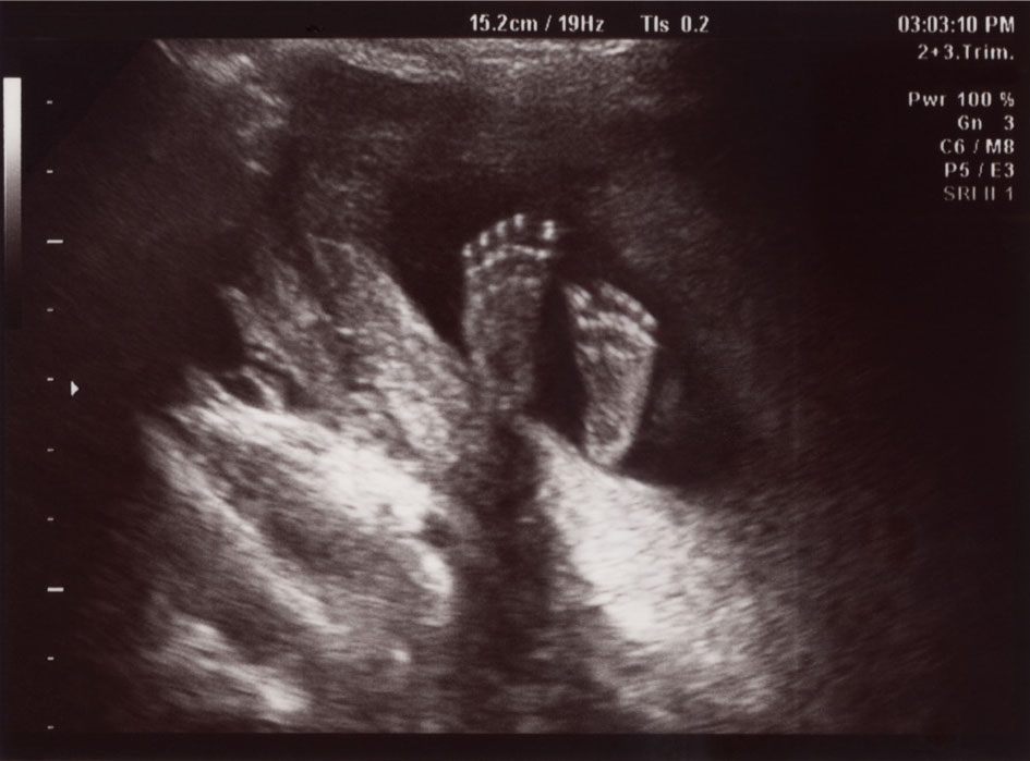 Ultrasound photo with baby's feet