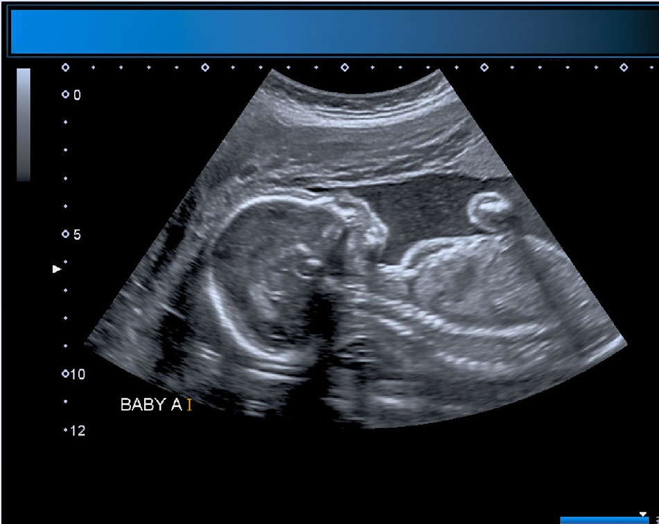 Ultrasound photo with profile of baby's head